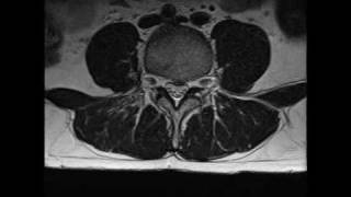 MRI of lumbar spine L4 L5 S1 disc bulge [upl. by Marigolda]