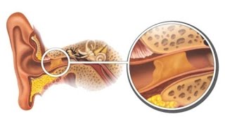 Cérumen et bouchons de cire [upl. by Mikahs]