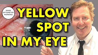 YELLOW SPOT IN EYE Pinguecula treatment from Youtube Eye Doctor amp Optometrist [upl. by Nosreme]