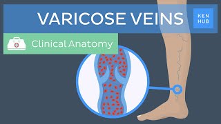 Varicose veins Definition causes symptoms and treatment  Kenhub [upl. by Kathlin530]