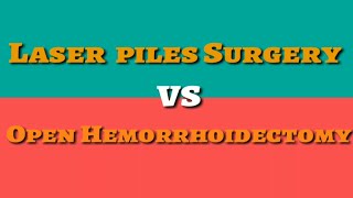 Laser piles Hemorrhoidoplasty surgery Vs Open Hemorrhoidectomy surgery [upl. by Hiller]