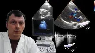 Pediatric Cardiac ultrasound  Bicuspid aortic valve with a regurgitation [upl. by Yerdna521]