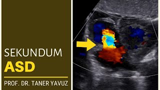 Sekundum ASD  Ekokardiyografi [upl. by Eeloj]