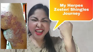 MY HERPES ZOSTER  SHINGLES JOURNEY English [upl. by Anihs]