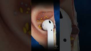 Why Your Earbuds Are Dirty earinfection earwax shorts viral creativelearning3d [upl. by Lizette]