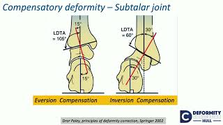 Compensatory theory of osteotomies around kneeEffect on Hip amp FampA alternate ways  H Sharma [upl. by Adeuga]