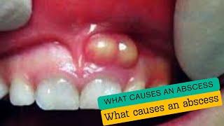 What causes an abscess [upl. by Enwad]