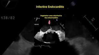 Infective Endocarditis [upl. by Jonie]