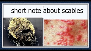 Wonderful presentation about Scabies Symptoms Cause and Treatments [upl. by Amlev5]