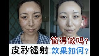 PicoSure Laser Review  BeforeampAfter皮秒镭射体验＋前后对比MsLindaY [upl. by Frohne781]