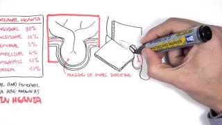 Introduction to Direct and Indirect Inguinal Hernia [upl. by Ashely]