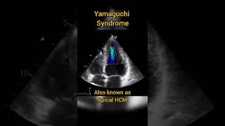 Apical Hypertrophic Cardiomyopathy HCM or Yamaguchi syndrome echocardiography [upl. by Rheta]