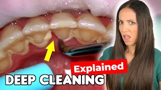 Dental Hygienist Explains Deep Cleaning Procedure [upl. by Jaime]