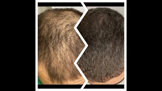 21 Month Finasteride13 Month Minoxidil2 Month Stemoxydine BeforeAfter [upl. by Yttak]