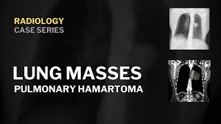 Pulmonary hamartoma  Radiology  truefisp [upl. by Ened592]