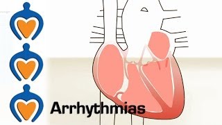 Arrhythmias  What is an arrhythmia and how is it treated [upl. by Iow]