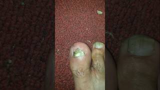 Ingrown nail remove ingrowntoenailtreatment [upl. by Honig507]