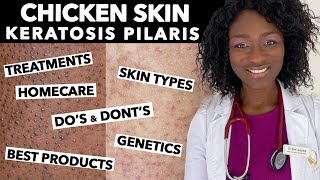 Keratosis Pilaris Chicken Skin  Treating Dry Bumpy Skin  Special Tips for Black Skin  Ask Doctor [upl. by Eloken]