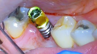 🦷 Full DENTAL IMPLANT PROCEDURE Before and After  Extraction Surgery amp Crown On Back Tooth Molar [upl. by Aztilay]