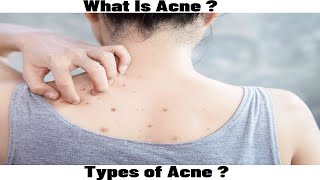 What Is Acne Types Of Acne [upl. by Asirrak]