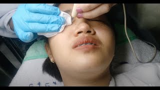 Vlog 35  Syringoma Removal  Laser Cauterization [upl. by Aneliram]