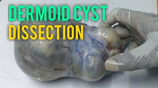 Big Size  Dermoid Ovarian Cyst Teratoma Dissection in Histopathology Laboratory essenceworld [upl. by Haimrej]