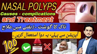 The NonSurgical Way to Treat Nasal Polyps [upl. by Naved]