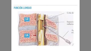 Punción lumbar y análisis de LCR [upl. by Ardnama303]