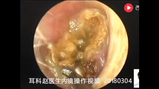 One case of cholesteatoma of external auditory canal was cleared in 15 minutes [upl. by Annaeirb293]