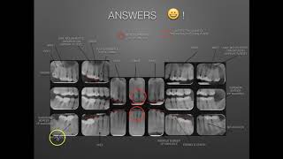 The Full Mouth Xray Survey Identification amp Film Mounting [upl. by Postman]