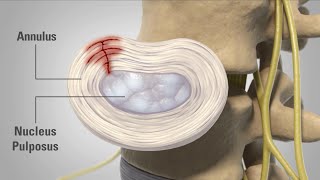 Patient Animation  Lumbar Degenerative Disc Disease [upl. by Iiette]