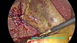 Laparoscopic Cholecystectomy For Acute Gangrenous Cholecystitis [upl. by Adnoved147]