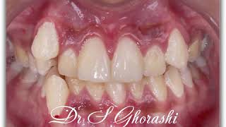 extraction of 4 premolars  drsaeed ghorashi [upl. by Mandel843]