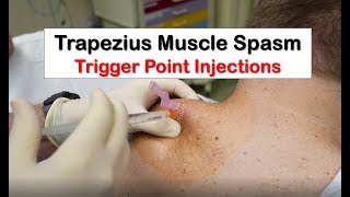 Trapezius Muscle Spasm Trigger Point Injection [upl. by Ynetsed]