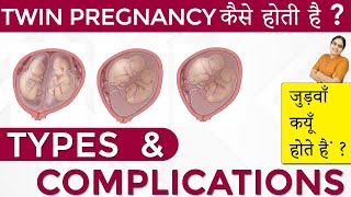 Twins Pregnancy Types Dichorionic Conjoined Monochorionic Diamniotic Monochorionic Monoamniotic [upl. by Slavic]