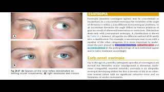 Kanski Clinical Ophthalmology Made Easy  Strabismus 8 [upl. by Berger295]