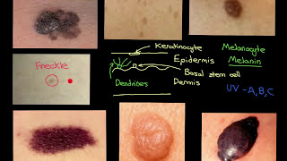 Melanocytic Lesions Part 2 [upl. by Analrahc233]