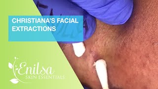 Christiana’s Facial Extraction [upl. by Mindy]