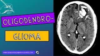 Oligodendroglioma [upl. by Dnalsor]