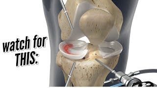 Meniscus Repair vs Meniscectomy [upl. by Leicester]