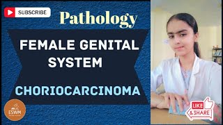 What Is CHORIOCARCINOMA In Pathology [upl. by Ehcnalb]