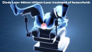 Laser Hemorrhoidoplasty LHP  IBI Healthcare Institute [upl. by Yniatirb]