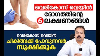 വെരികോസ് വെയിൻ രോഗത്തിന്റെ 6 ലക്ഷണങ്ങൾ  Varicose veins Malayalam Video [upl. by Akamahs]