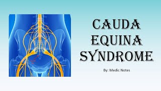 Ortho Cauda equina syndrome  definition causes treatment [upl. by Asennav]