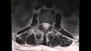 Infectious Arachnoiditis [upl. by Herrick]