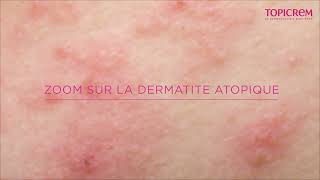 Tout Savoir sur la Dermatite Atopique [upl. by Nalhsa58]