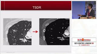 Treatment Strategy for Ground Glass Opacity and Tiny Lung Nodules [upl. by Star577]