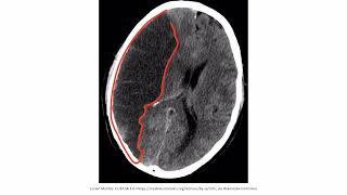 Ischemic Stroke  Neurology  video   part 1 educational full video English [upl. by Yeldahc301]