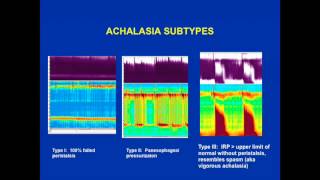 Achalasia is the esophageal motility abnormality [upl. by Madison297]