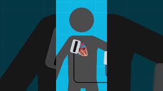 How Do Defibrillators Actually Work DEBUNKED moviemyths sciencefacts debunked [upl. by Pauli]